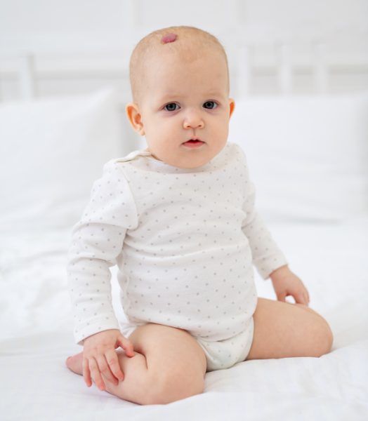 a baby girl of six months with a red hemangioma or a benign tumor on her head on a white cotton bed in a bodysuit on a bed at home