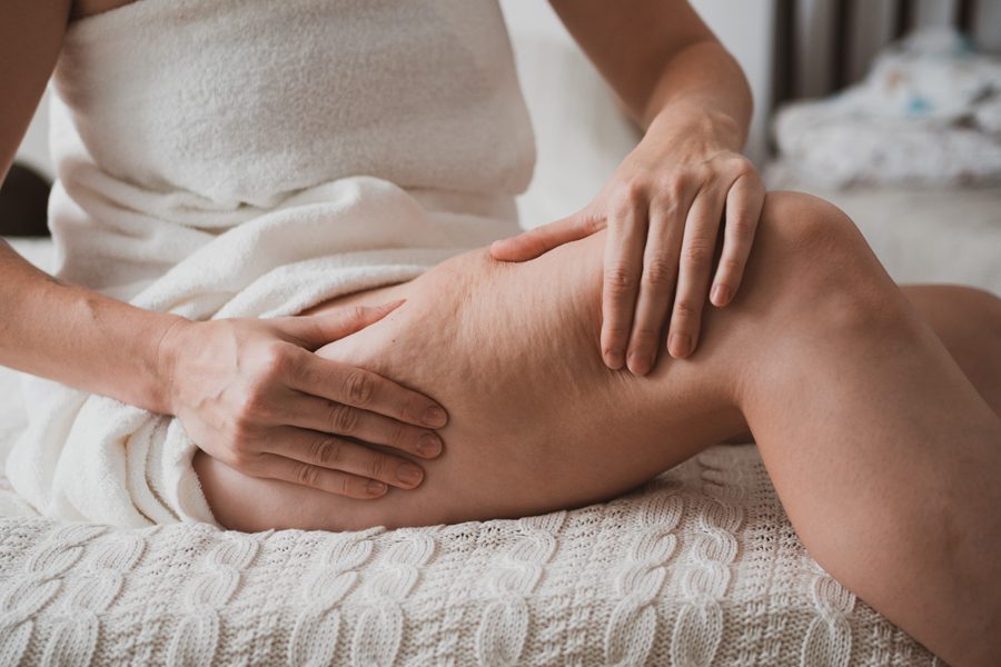 Close-up of female body with cellulite, woman makes massage against cellulite with her hands. Bodypositive, photo without retouching