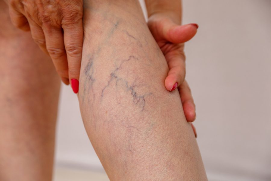 Elderly woman in white panties shows cellulite and varicose veins on a light isolated background. Concept for medicine and cosmetology.