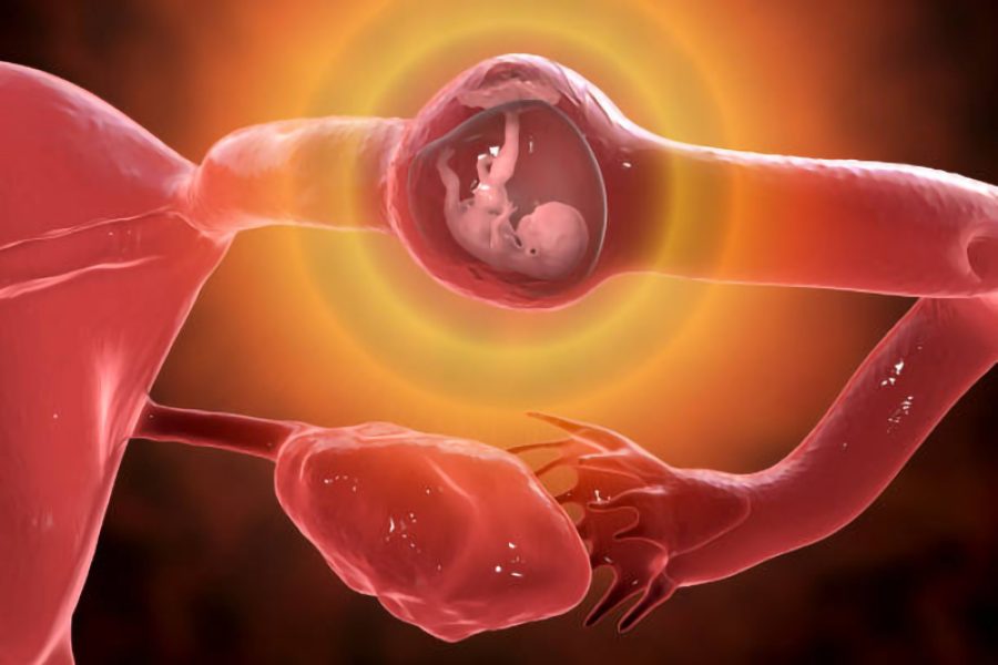 Tubal ectopic pregnancy, 3D illustration showing an 8-week human fetus implanted in the fallopian tube instead of uterus