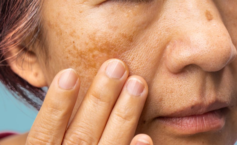 Menopausal women worry about melasma on face.