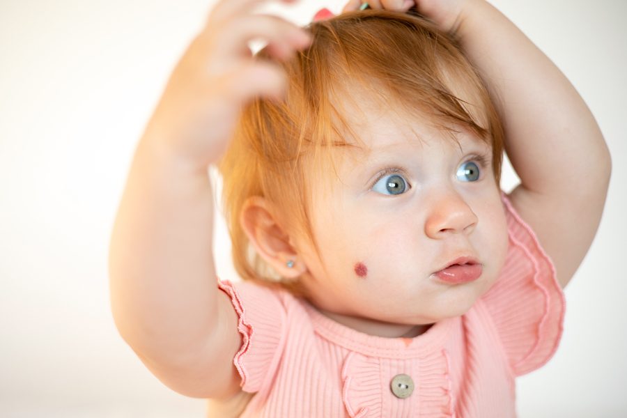 Portrait of a charming funny red-haired baby girl with blue eyes and a birthmark on her cheek. Hemangioma. Light background. Lifestyle. High quality photo