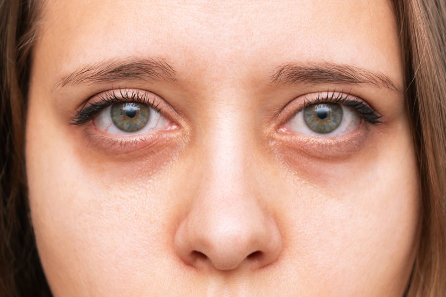 womans-eyes-with-dark-circles-eyes-with-red-capillaries